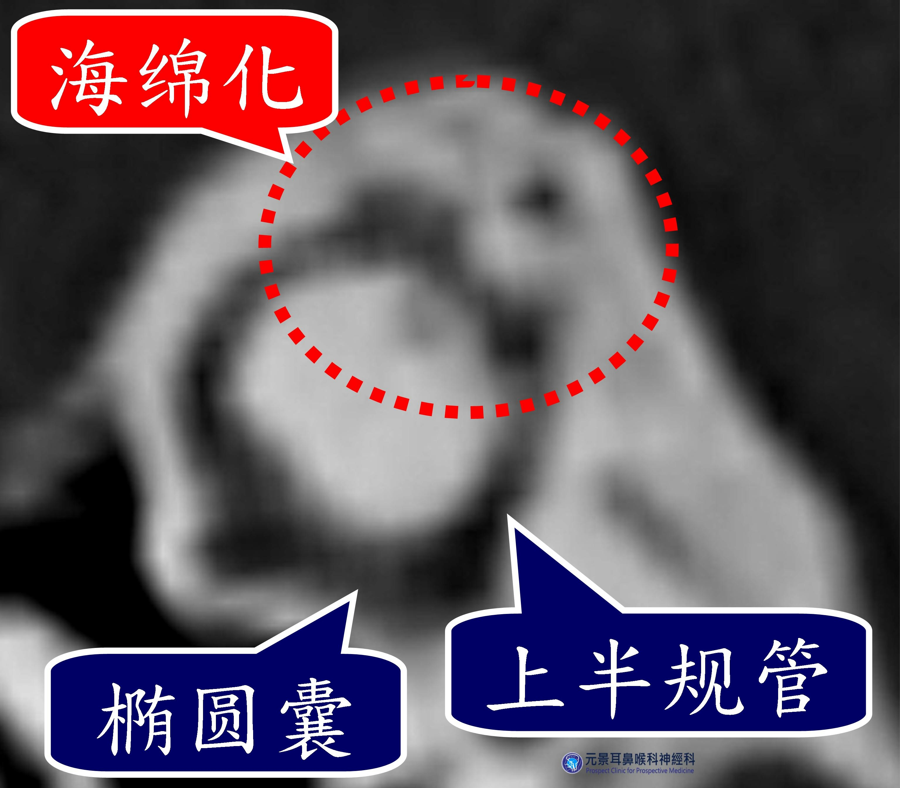 突发性晕眩10年缠身 台湾晕眩权威发现竟是颞骨内器官病变